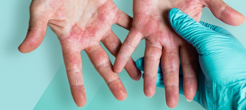 Аллергические дерматиты от воздействия химических факторов